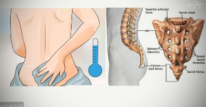 Tailbone Pain aka Coccydynia - Kiran Clinics