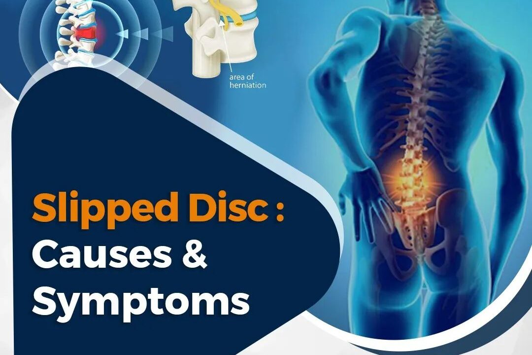 Slipped Disc: Causes and Symptoms