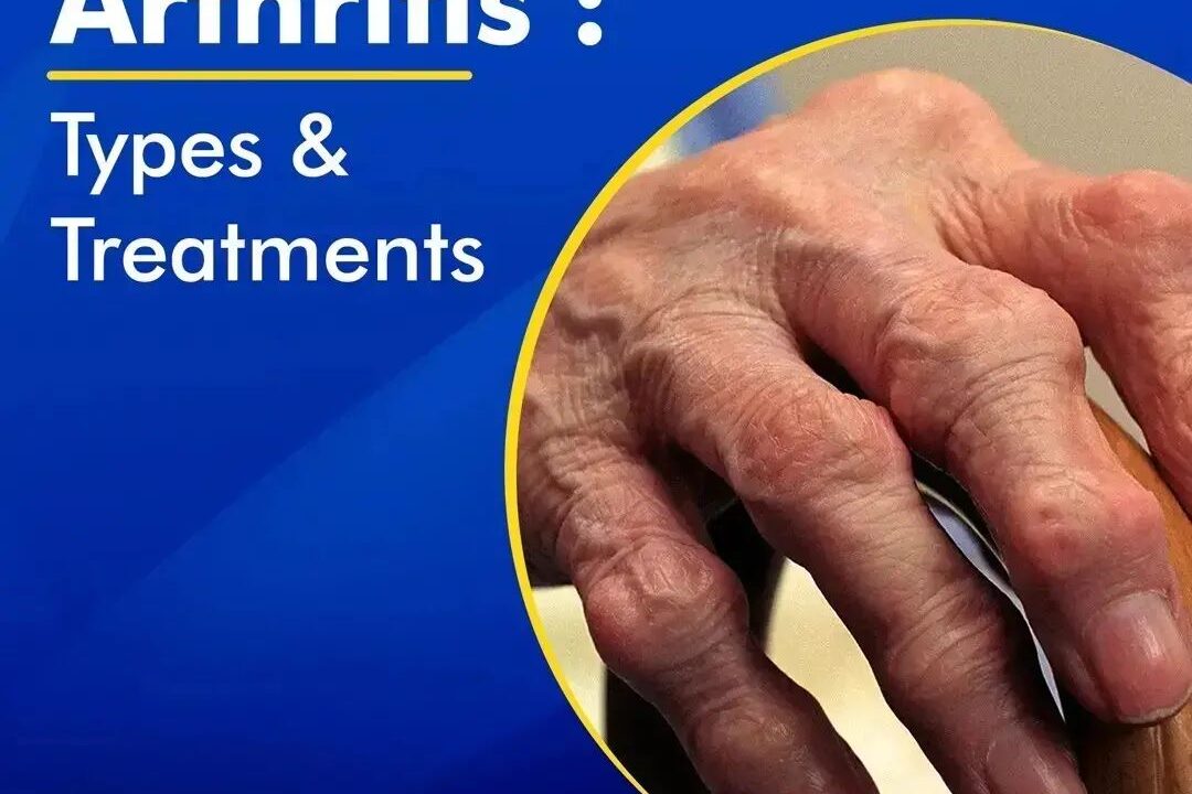 Arthritis – Types & Treatments