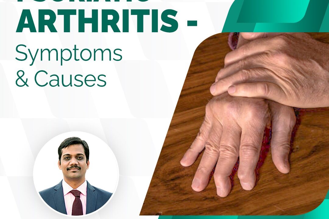 Psoriatic Arthritis – Symptoms & Causes