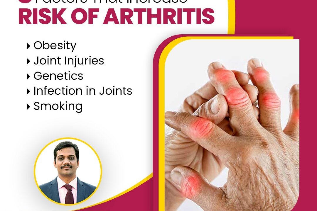 5 Factors That Increase Risk of Arthritis