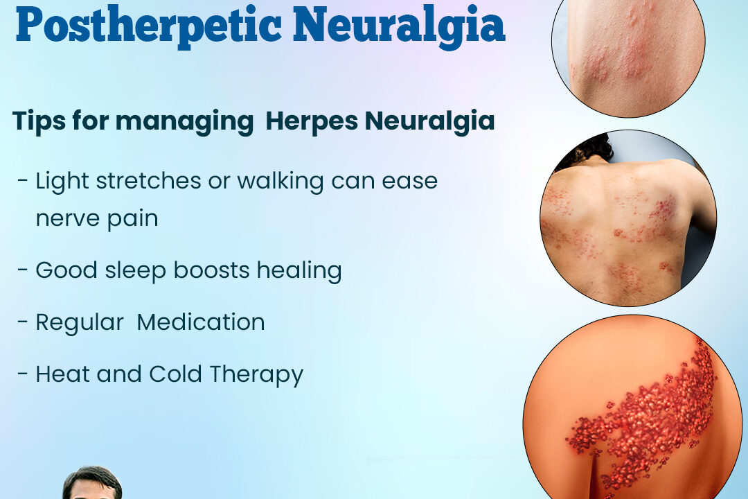 Tips For Managing Herpes Neuralgia