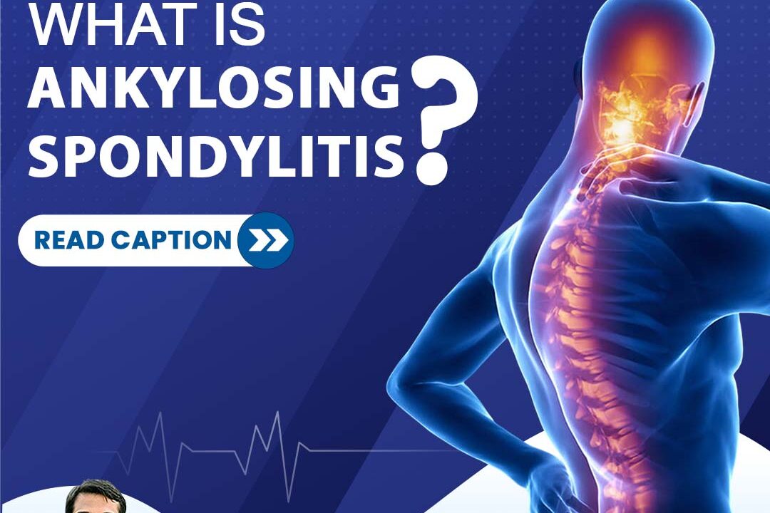 What is Ankylosing Spondylitis?