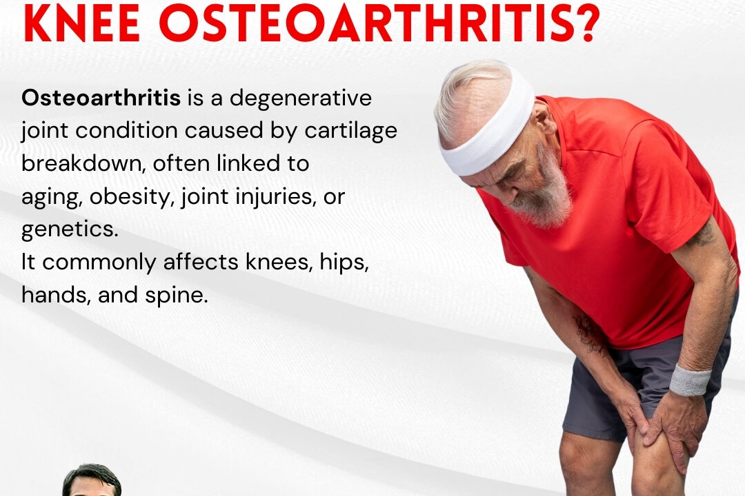  What is Knee Osteoarthritis? 